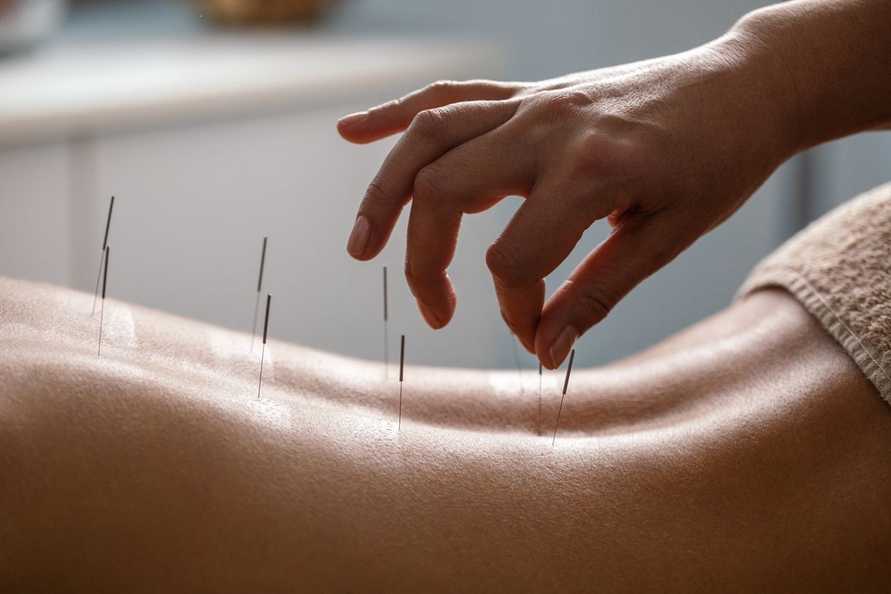 acupuncture for lower back pain