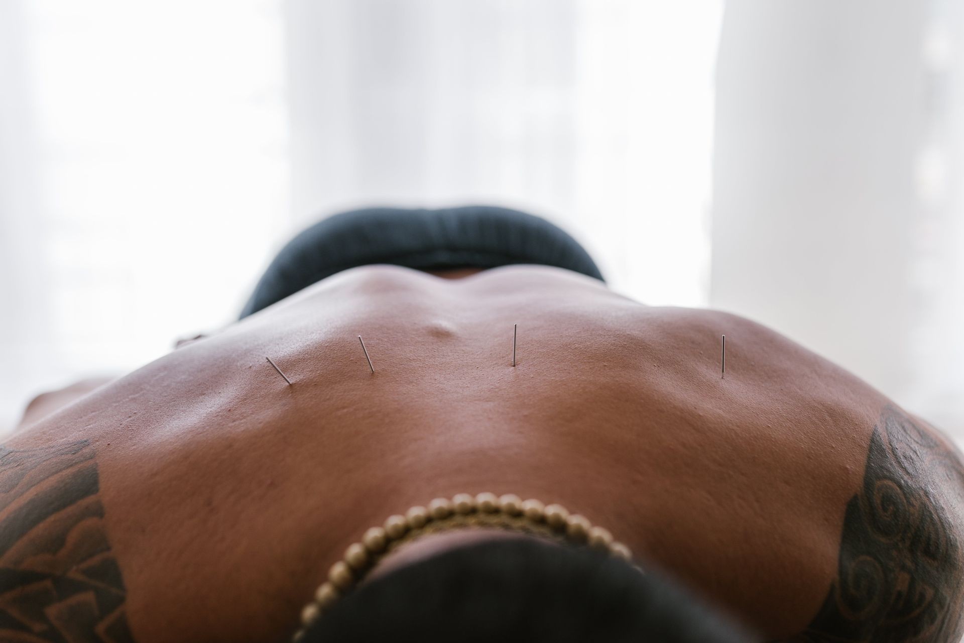 acupuncture for upper back pain
